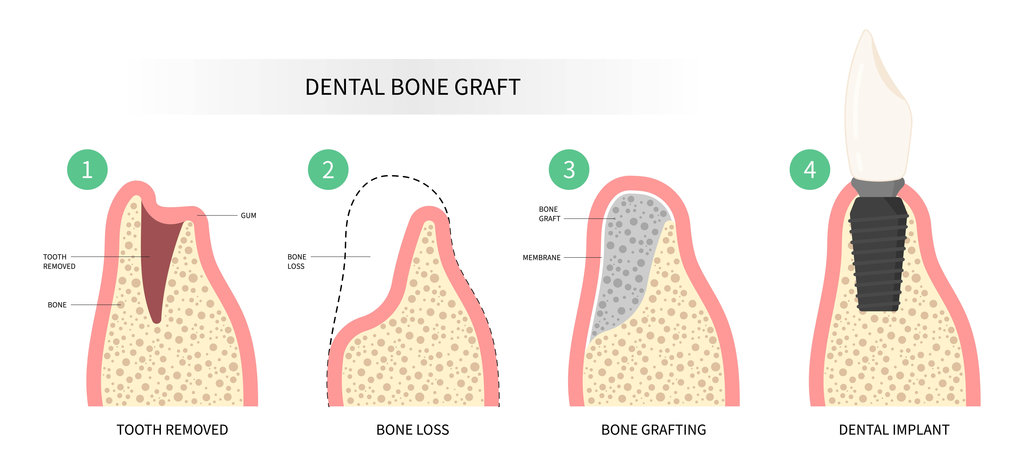 Dental surgery for oral teeth implant with bone graft procedure