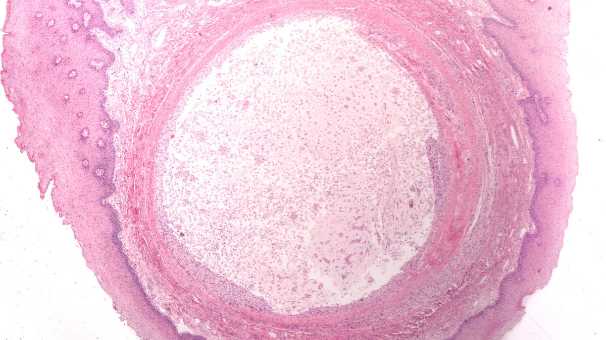 Microscopic image of a mucocele (mucus cyst), a fluid-filled swelling that occurs on the lip or the mouth which develops when accessory salivary glands become plugged with mucus.
