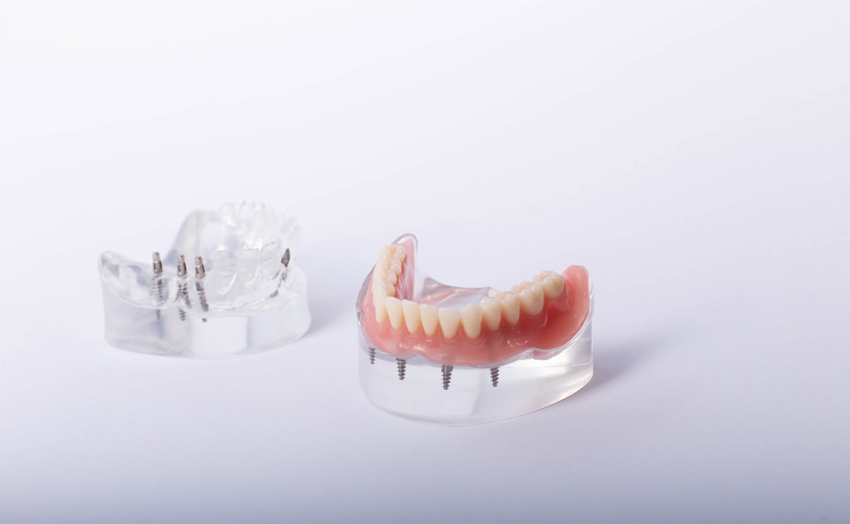 Removable mandibular prosthesis All on 4 system supported by implants.
