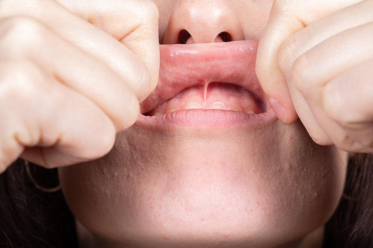 Medical inspection of the superior labial frenulum to evaluate the need for frenectomy oral surgery
