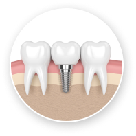 Illustration of a single dental implant between natural teeth